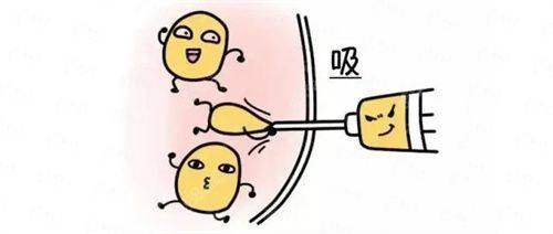 三、扬州韩美整形面部吸脂真人实例对比