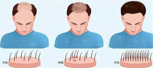 三、扬州大麦植发的发际线种植价格贵吗?