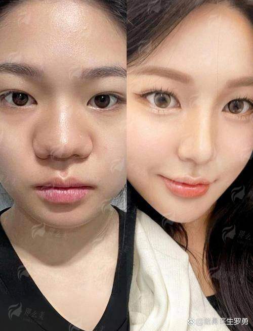 三、如何预约张鑫医生鼻综合手术