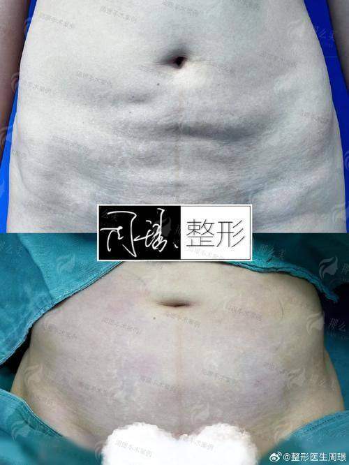 四、扬州韩美整形面部吸脂如何预约？