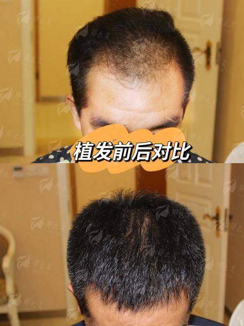 发际线种植哪家强？扬州大麦植发真实案例全公开+新颜智尚预约
