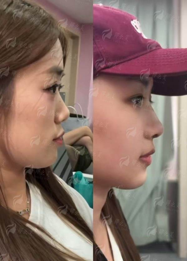 四、鼻综合手术前后的注意事项