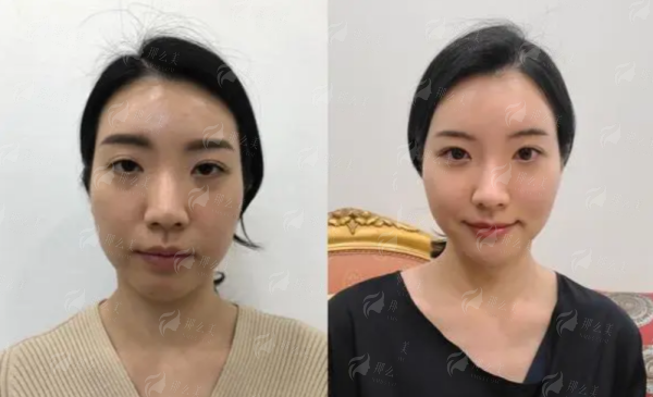 三、上海华 山医院丁志医生双眼皮手术如何预约？