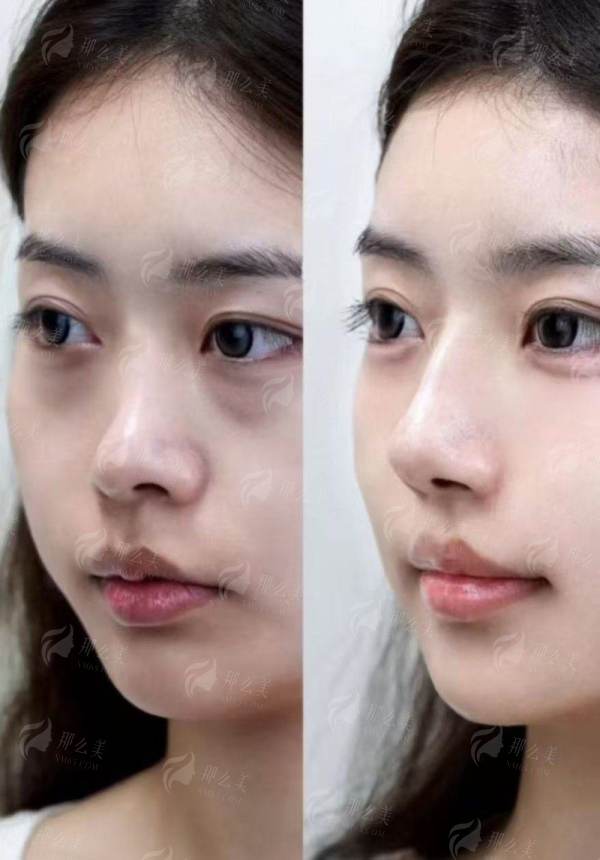 二、李信锋鼻修复价格贵吗?深圳宝丽收费透明吗?