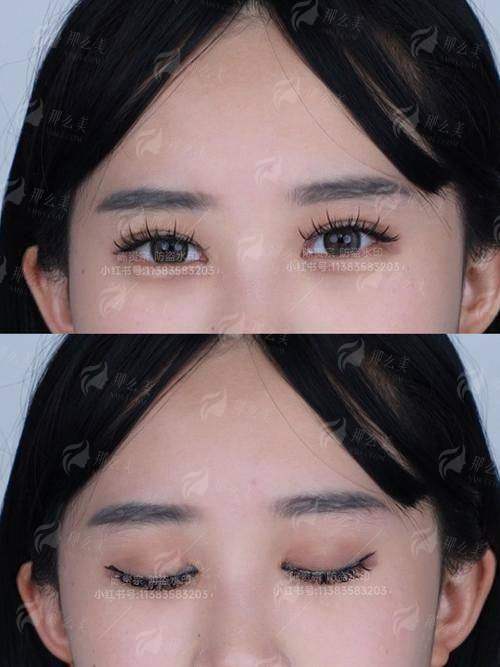 三、青岛诺德马昕眼修复价格是多少？