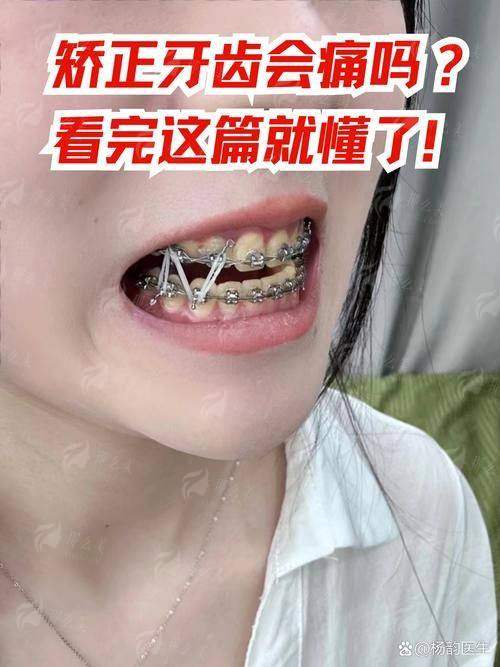 三、深圳汇港口腔牙齿隐形矫正的流程和注意事项