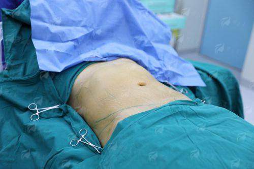 三、广州雅贝壹腰腹吸脂的医生怎么选？