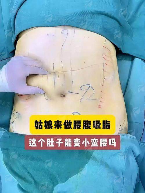 想做腰腹吸脂？广州雅贝壹新颜智尚一键预约，了解详细价格与特色技术！