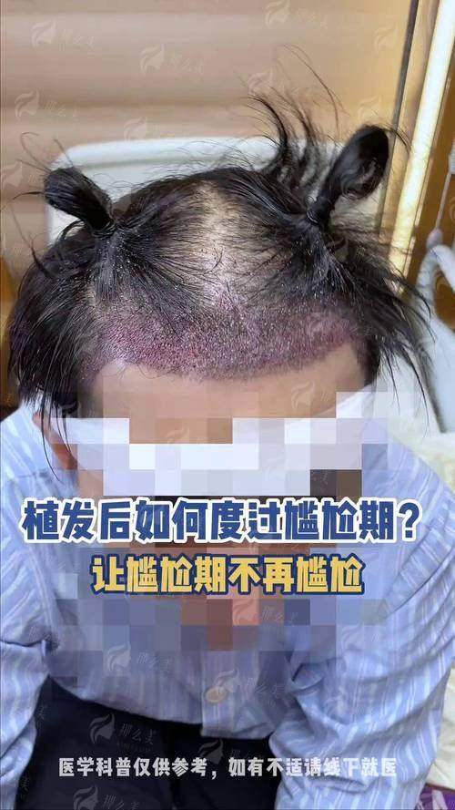 四、如何预约温州青禾植发的郑方成院长？