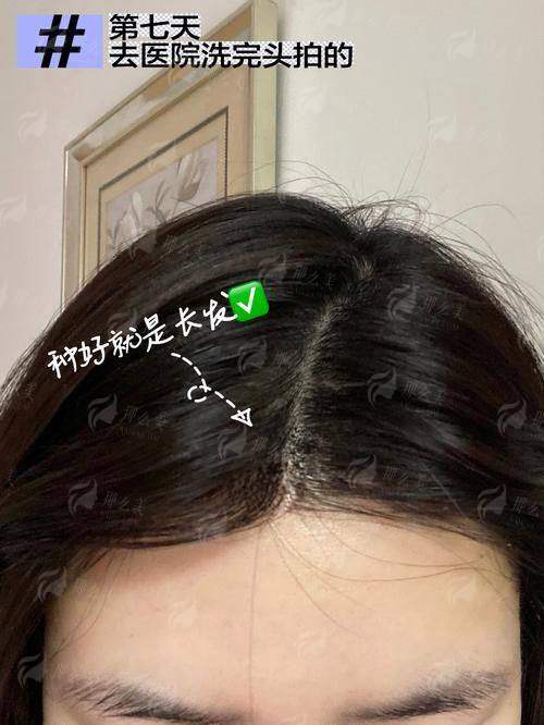 一、温州青禾植发的毛发种植技术怎么样？