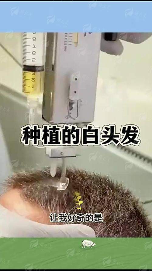 二、温州青禾植发的毛发种植成效能维持多久？