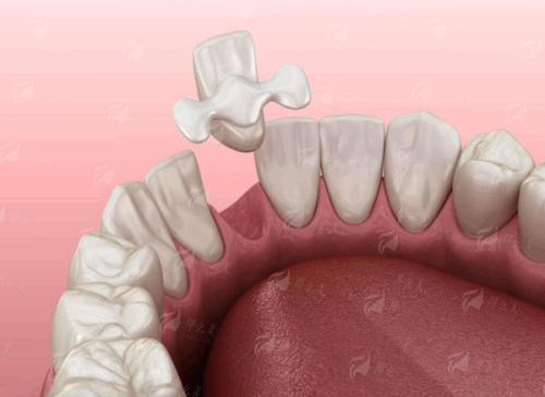 想知道深圳汇港口腔牙齿隐形矫正价格？看案例推荐，一键预约开启变美之旅！