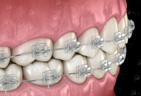 二、兰州润玉口腔隐形矫正适合哪些人?