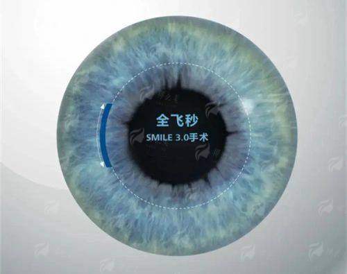 <strong style="color: red;">角膜塑形镜：控制近视发展的有效选择</strong>