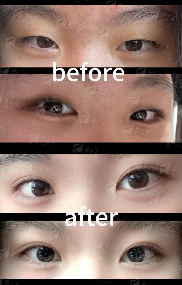 三、山东玖美整形医院的双眼皮手术价格贵吗?