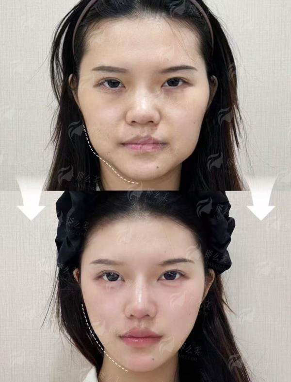 四、如何预约山东玖美整形医院的双眼皮手术?