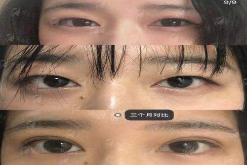 一、平顶山星美杨召辉医生双眼皮技术好在哪？