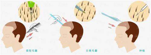 四、贵阳妍僖整形如何预约植发？