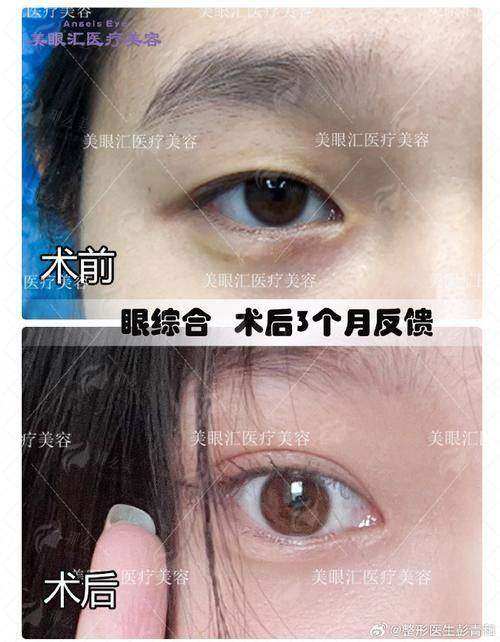 三、半岛超声炮的术后护理和注意事项