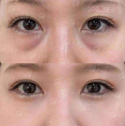 一、湖北宜昌亚太整形美容医院的祛眼袋技术怎么样?