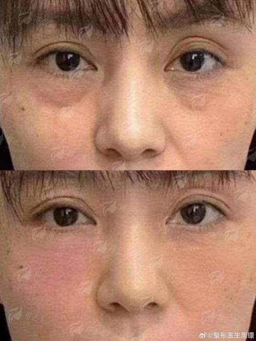 三、湖北宜昌亚太整形美容医院的祛眼袋价格贵吗?