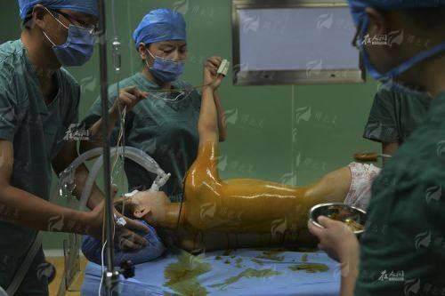 三、惠州时光假体隆胸的术后修复与护理