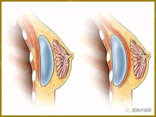 二、惠州时光叶明龙假体隆胸的技术特点