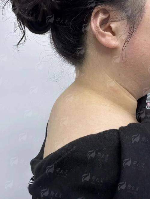 四、超微乳化祛富贵包价格与预约方式详解