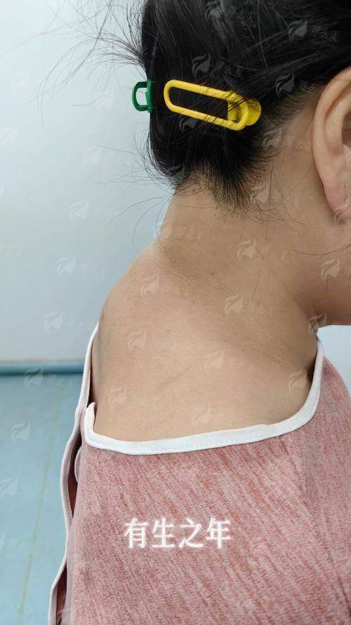 三、在欣姿美做超微乳化祛富贵包的全流程指南