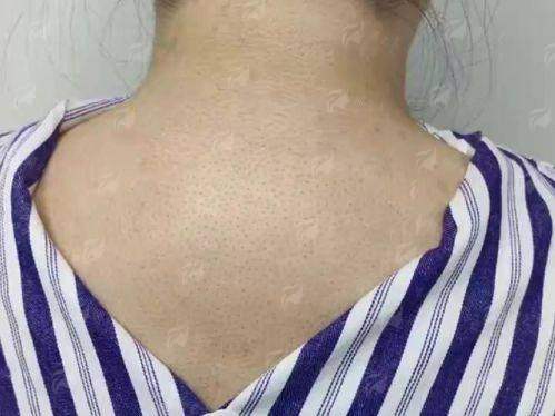 一、湖南长沙欣姿美医疗美容的超微乳化祛富贵包技术强在哪?