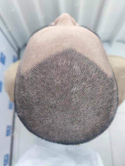 一、贵州黔南菲梵医美的发际线种植技术怎么样?