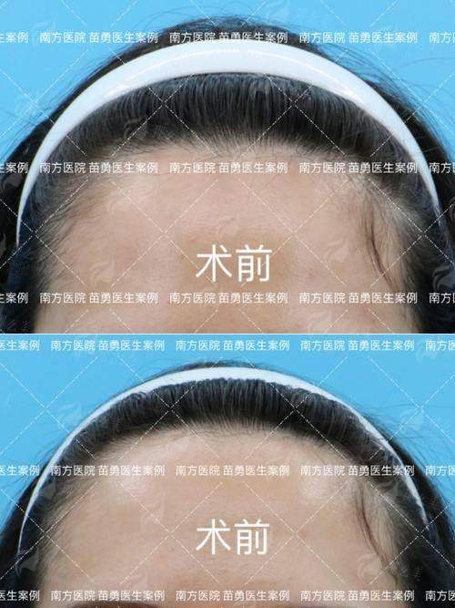 二、贵州黔南菲梵医美发际线种植适合哪些人?