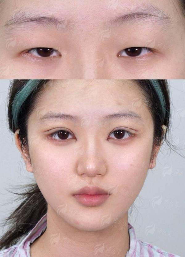 四、平顶山星美杨召辉医生双眼皮怎么预约？