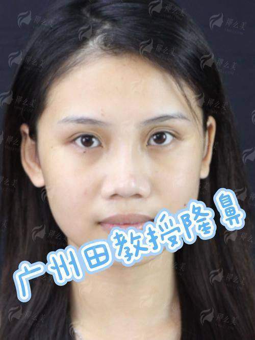 三、福建福州海峡美容医院假体隆鼻有哪些特色?