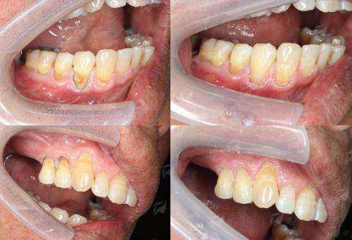 二、种植牙/矫正多少钱?2024全新价目表