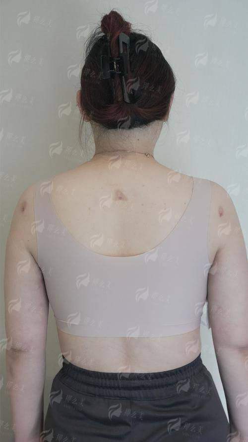 四、东莞美立方医美腰腹环吸怎么预约？