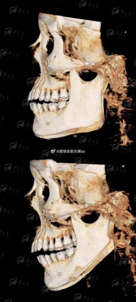 三、项昌峰医生磨骨手术成效如何？