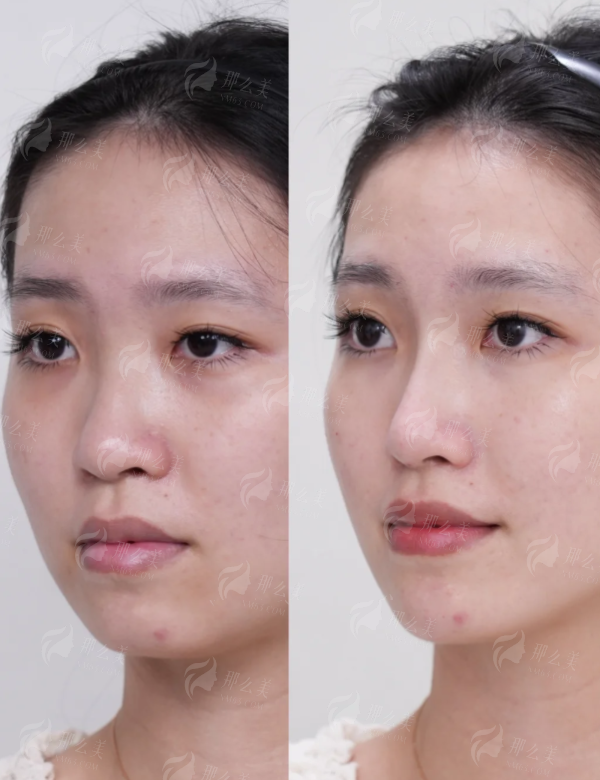 四、如何预约福建福州海峡美容医院的假体隆鼻?