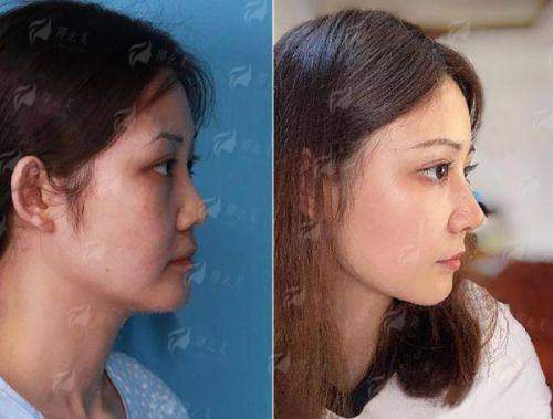 一、湖北中爱整形的假体隆鼻技术怎么样?