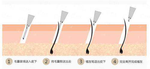 三、广州植发医院价格大比拼