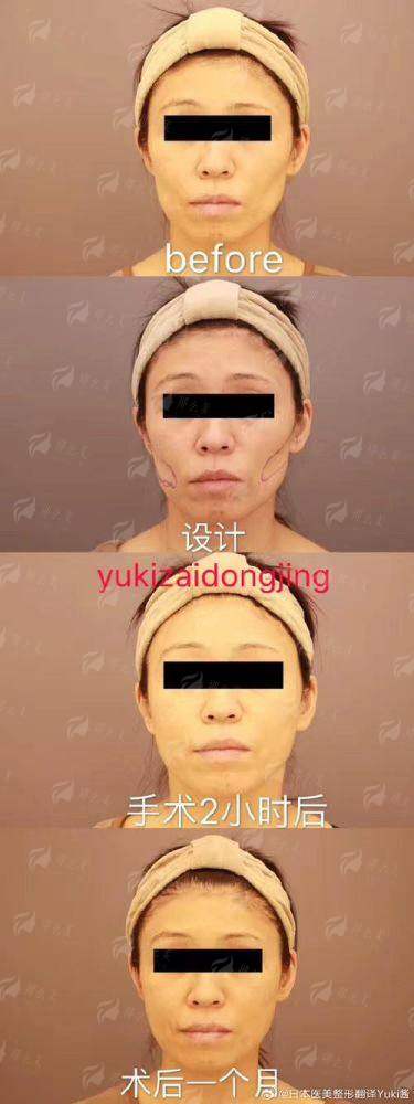 四、如何预约广西柳州华美医疗美容的脂肪填充？