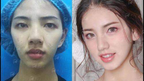 三、广西柳州华美医疗美容的脂肪填充有哪些注意事项？