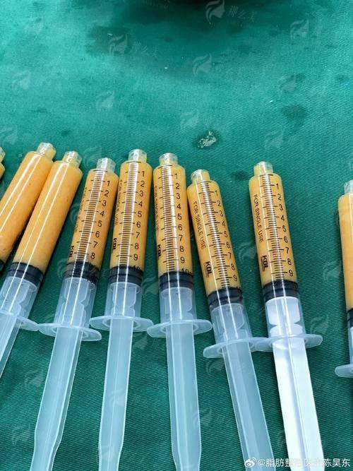 二、广西柳州华美医疗美容的脂肪填充适合哪些部位？