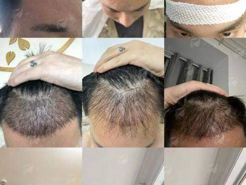 四、如何选择适合自己的广州植发医院?