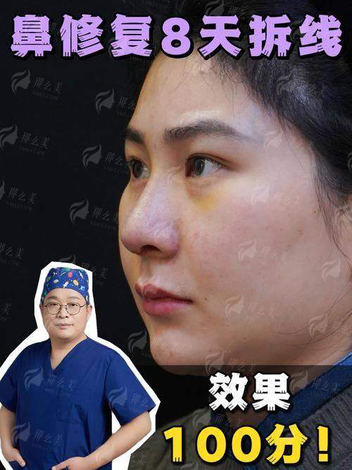 三、成都刘昭政医生鼻修复价格贵不贵?