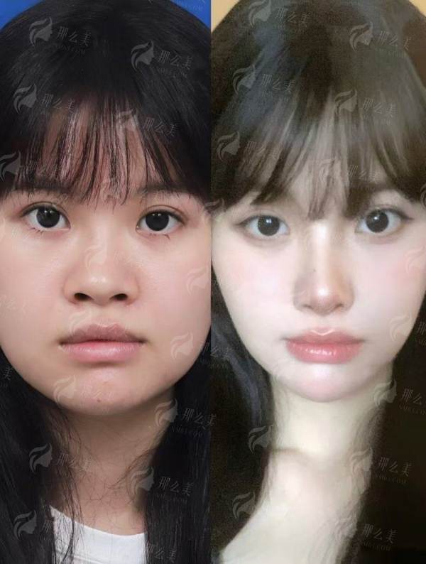 四、湖北中爱整形假体隆鼻怎么预约?