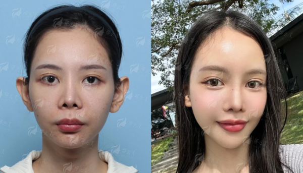 四、如何预约北京加减美白永辉医生的双眼皮手术？