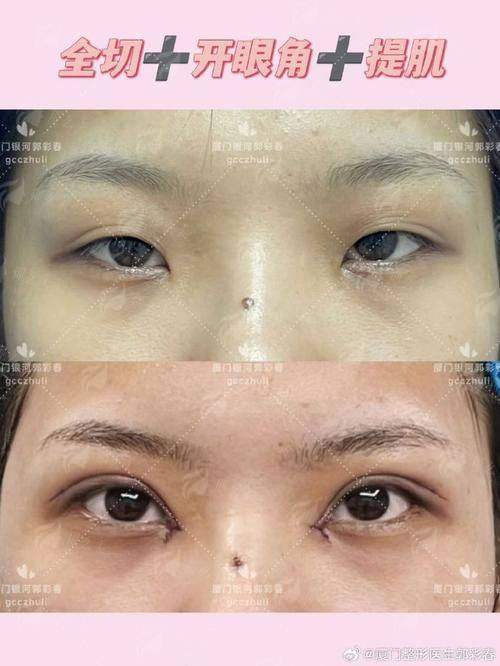 三、广西 南宁东方整形邓皓畇医生双眼皮预约及面诊流程