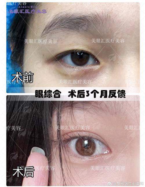 四、杭州虎山林畔医美中 心的王新宇、曾萍英医生，如何根据自身情况选择？