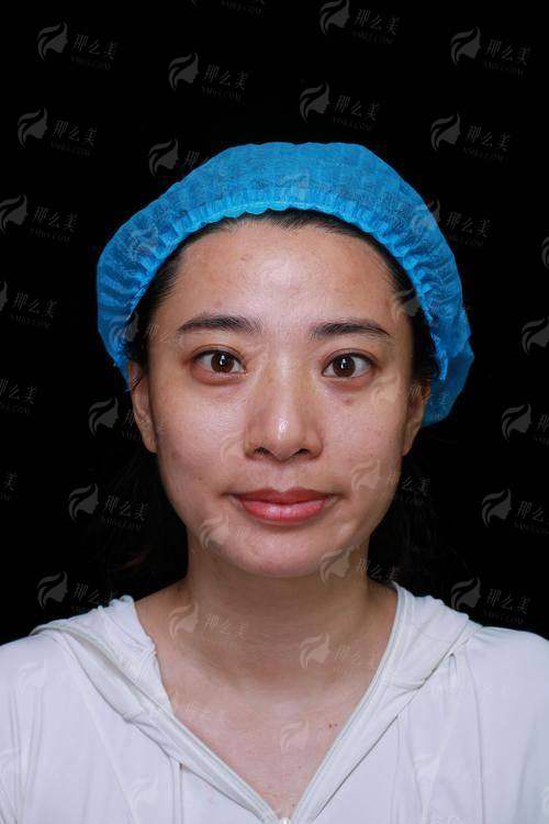 二、选择南通爱时光医疗美容的无痕眼袋，需要关注哪些核心？